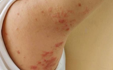 chronická dermatitida, alergie a vyrážka na těle. - impetigo - stock snímky, obrázky a fotky