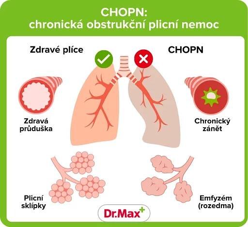 CHOPN: Chronická obstrukční plicní nemoc | Dr. Max