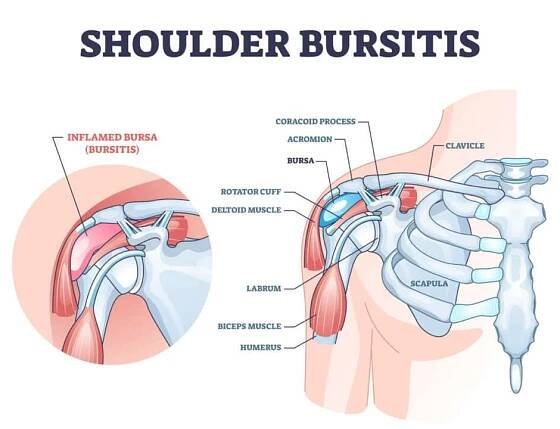 Rameno bursitida jako lékařské bolestivé Bursa zánět obrys diagram — Ilustrace