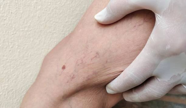 the varicose veins and spider on the leg. - lipedém - stock snímky, obrázky a fotky