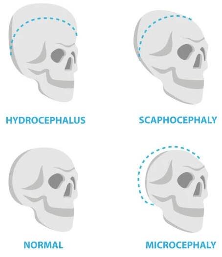 sada lebek normálních a deformovaných, hydrocefalus, lopatkafalie, mikrocefalie vektor ploché ikony, lebka lékařské ilustrace, anatomické infografické prvky izolované na bílém pozadí. - hydrocefalus stock ilustrace
