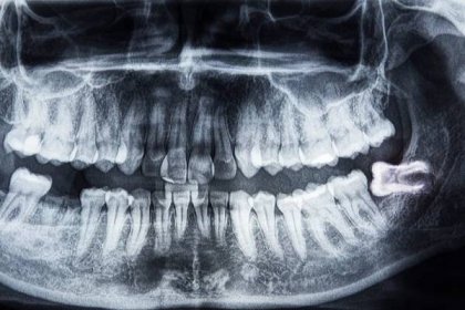 zuby rentgen a moudrost zub - zub moudrosti - stock snímky, obrázky a fotky