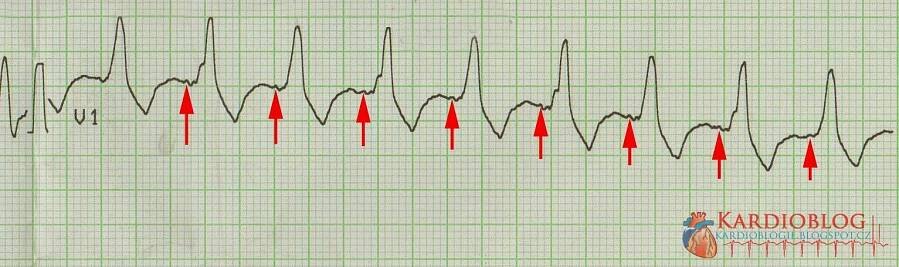 (POKROČILÍ) Tachykardie s alternujícími QRS komplexy - Kardioblog