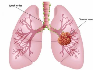 Ilustrace z příznaků rakoviny plic — Ilustrace