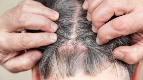 Jak se vypořádat s lupénkou vlasové pokožky? | BIODERMA