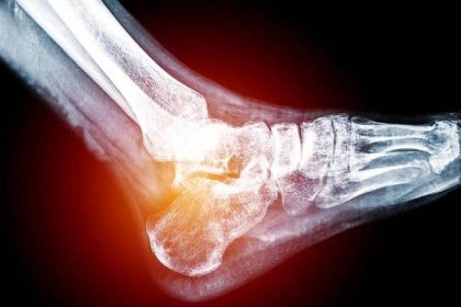 bolestivá pata rentgenová lidská noha - patní kost - stock snímky, obrázky a fotky