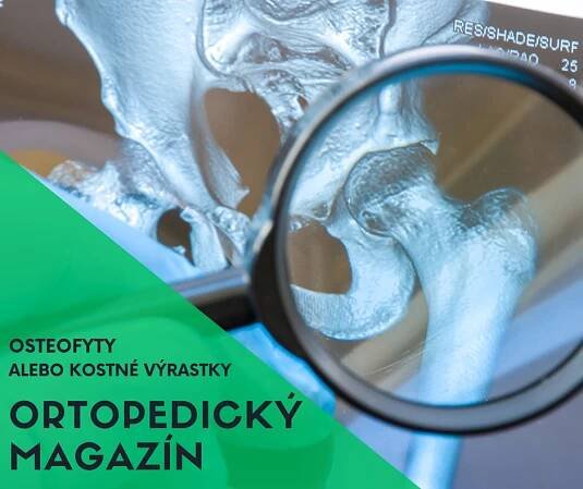 Čo sú osteofyty alebo kostné ostrohy? Príčiny, prevencia a ich liečba