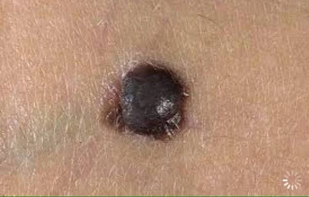 Melanoma (ICD-10: С43) - Online consultation AI dermatologist