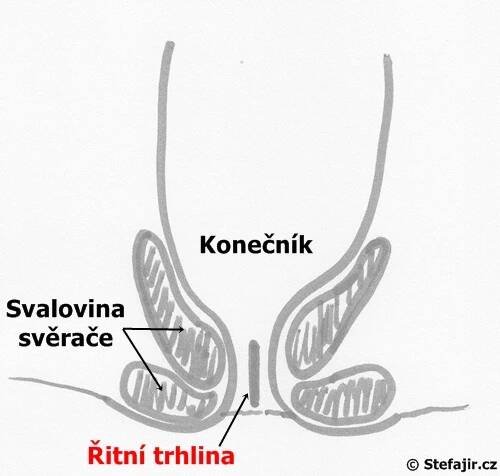Řitní trhlina | Medicína, nemoci, studium na 1. LF UK