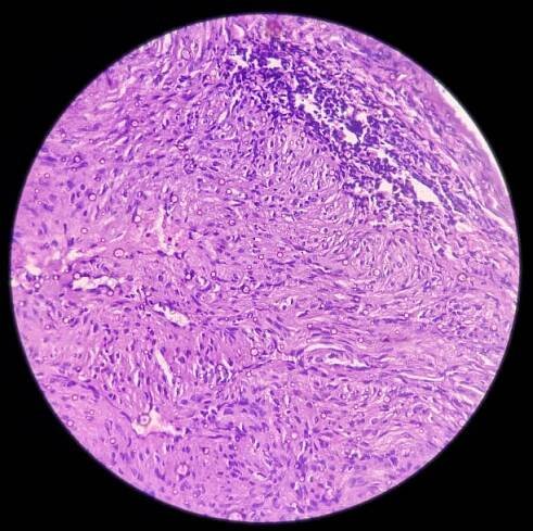 tkáň z prsteníčku: neurofibrom, typ benigního nádoru, neurofibromatóza - neurofibromatóza - stock snímky, obrázky a fotky