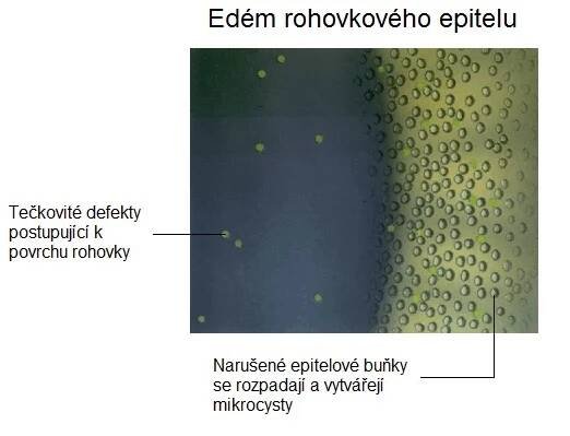 epitelové cysty