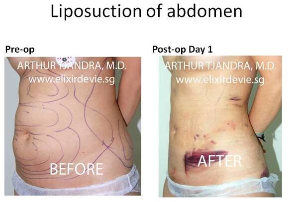 Liposuction Before and After photos by Dr Arthur Tjandra of L’Élixir de Vie Page 1