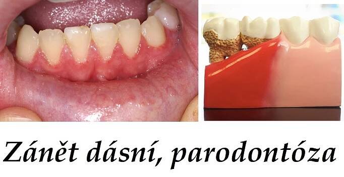 Dásně, zánět dásní, parodontóza - byliny, bylinky, babské rady, ústní voda, zubní olej - Bylinky pro všechny