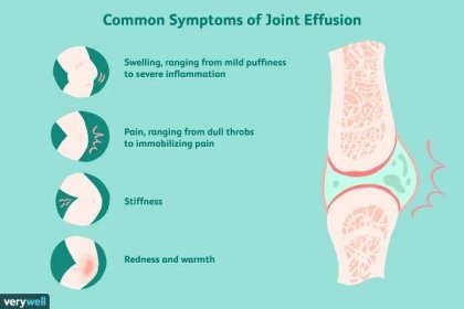 common joint effusion symptoms