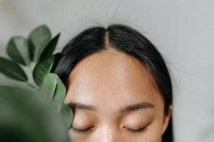 Forehead bulging veins. Are they genetic or what are the other causes?