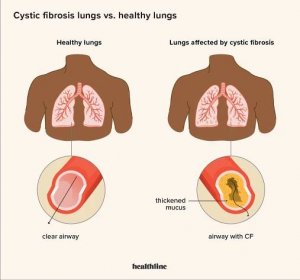 Ilustrace rozdílu mezi zdravými plícemi a těmi s cystickou fibrózou.