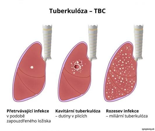 Tuberkulóza - príznaky a liečba