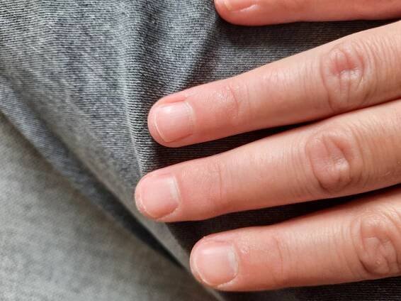 Příběh: Červené proužky u konce nehtů