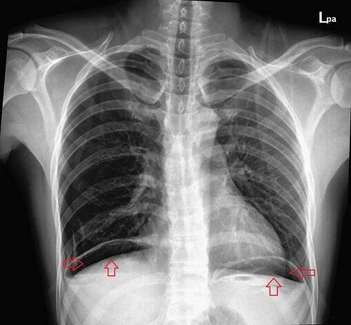 Perforácia gastroduodenálneho vredu - Medicína a chirurgia