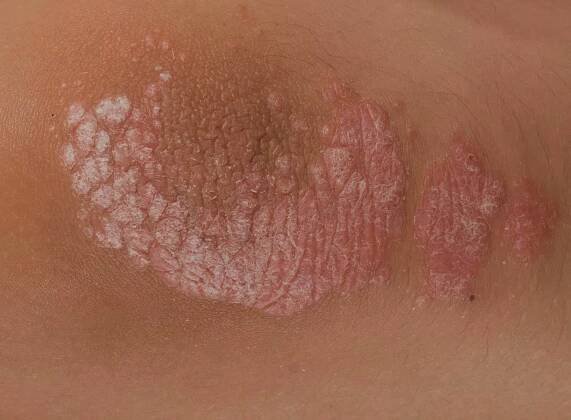 Psoriáza - DERMAREVOLTA