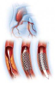 coronary artery illustration with mesh