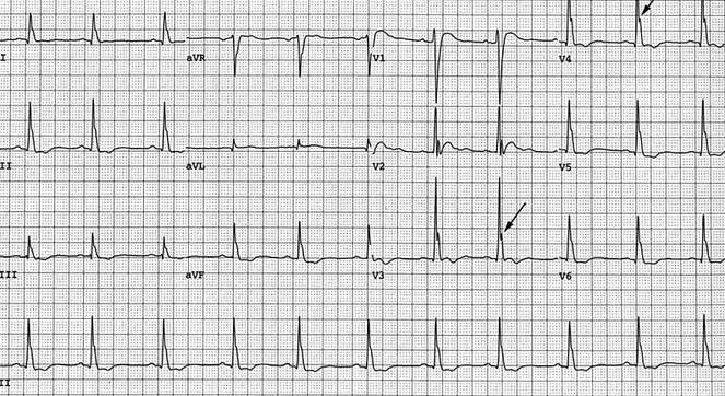 ECG J wave - notch, and hypercalcaemia