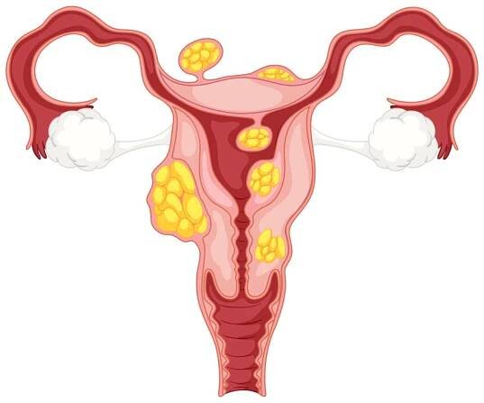 Lékaří varují všechny ženy před syndromem polycystických vaječníků. Problém, o kterém se příliš nemluví!