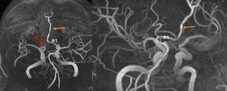 a anterior azygos - MRA