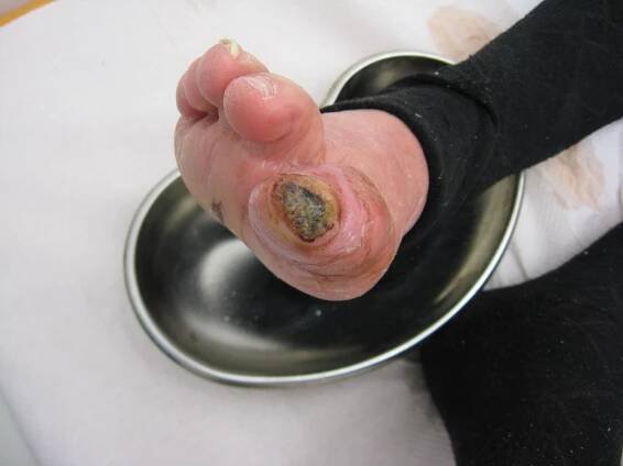 Diabetická noha – WikiSkripta