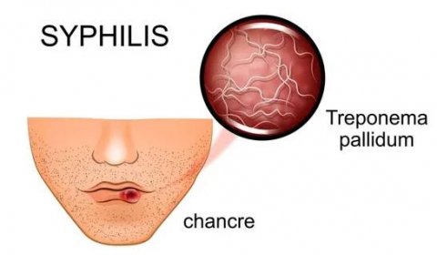Ilustrace syfilis. původce a příznaky — Ilustrace