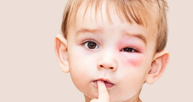 Co na spáleniny od sluníčka, úžeh a štípnutí od vosy? Babské rady ZDE! – Maminka.cz