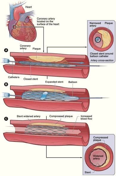 Stent