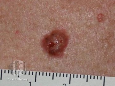  Around 75 per cent of all skin cancers are basal cell carcinomas, pictured