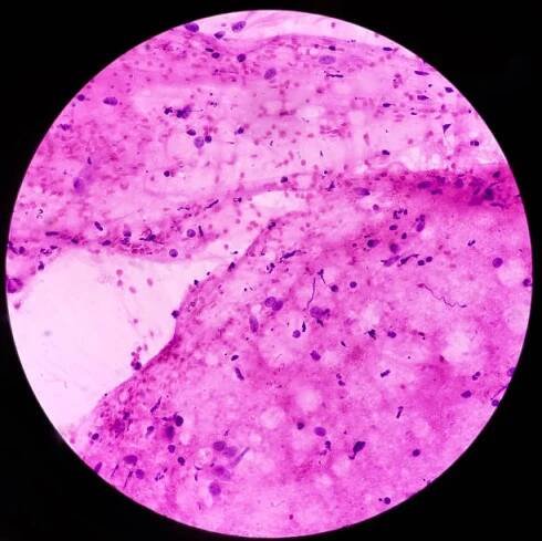 neurofibromatózy. neurofibrom (fna cytologie), mikroskopický obraz ukazuje vřetenovité buňky s vlnitými jádry. genetické poruchy s tvorbou nádorů v nervovém systému. - neurofibromatóza - stock snímky, obrázky a fotky