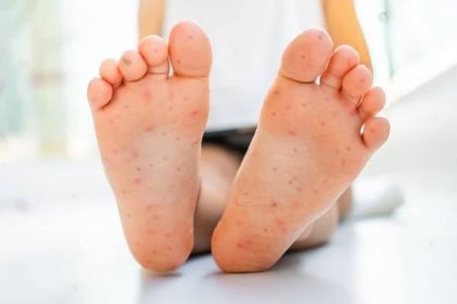 enterovirus noha - paže - ústa. vyrážka na těle dítěte. cocksackie virus. - nemoc rukou nohou a úst - stock snímky, obrázky a fotky
