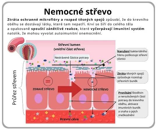 Jak se vypořádat s nadměrně propustným střevem a znovu získat kontrolu nad svým zdravím? | Zdravé střevo-zdravý člověk