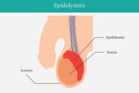 illustration of epididimitis (inflamasi epididimis). Epididymitis is inflammation of the epididymis which is generally caused by a bacterial infection. eps 10
