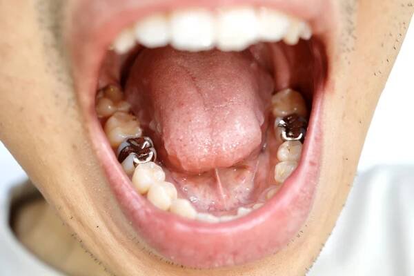 Metal fillings in mouth