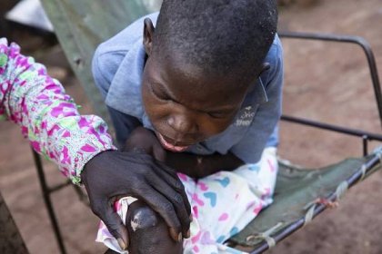 Děti se začnou kývat a pak umřou. Jižním Súdánem se šíří divná nemoc, ničí mozek