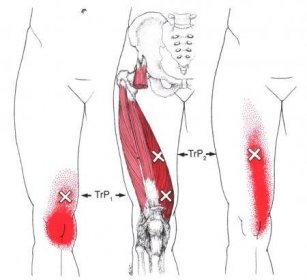 Bolest na vnitřní straně kolene - příčiny - Spoušťovýbod