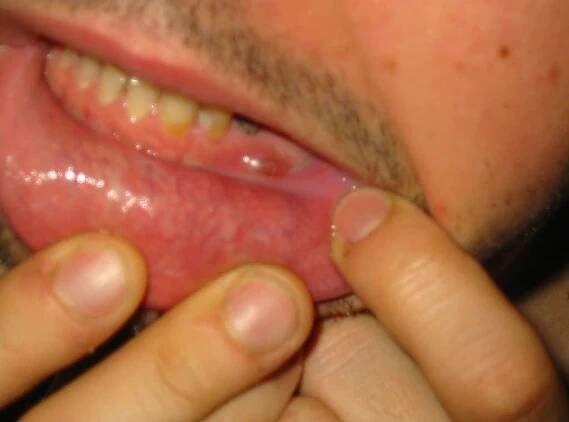 absces