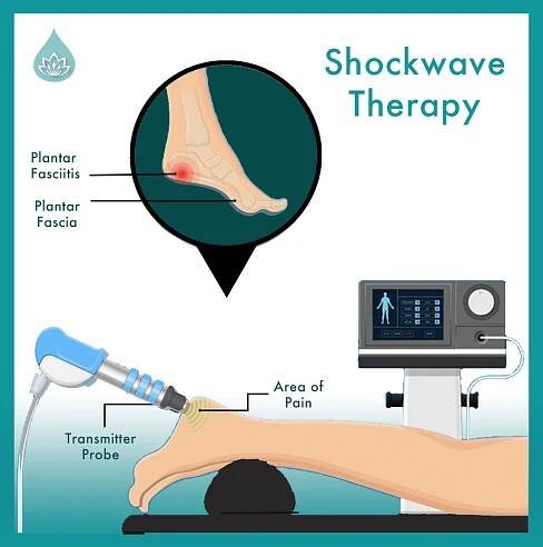 Benefits of Shockwave