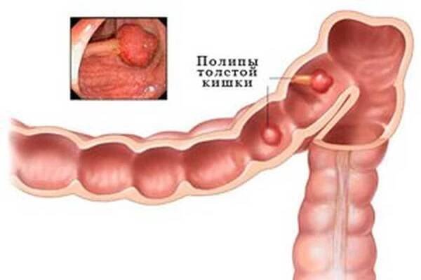 Příčiny, příznaky, léčba a odstranění polypů v konečníku / Polypy