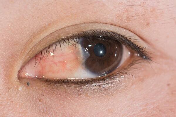 Pterygium Surgery