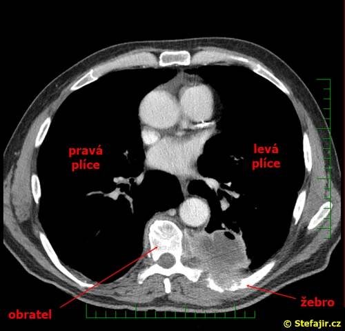 Nález 28 - Tumor plíce postihující žebro | Medicína, nemoci, studium na 1. LF UK