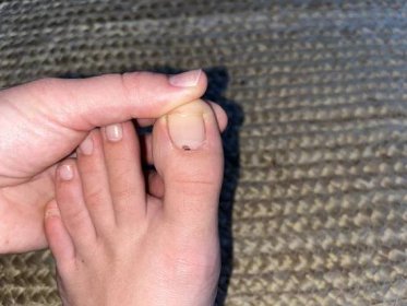Gangréna na prstech u nohou