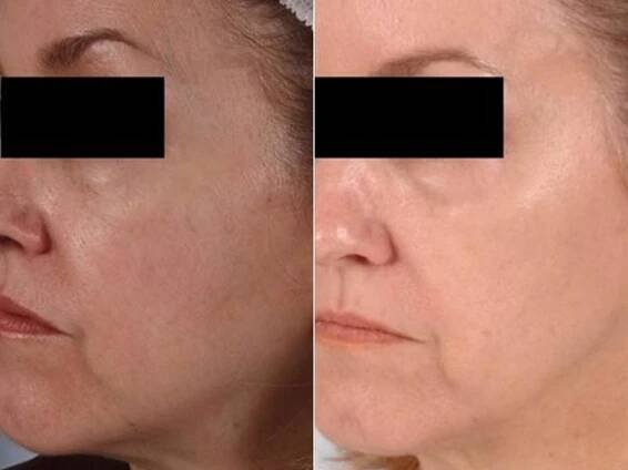 Peels and Microdermabrasion Before & After Photos | W Cosmetic Surgery