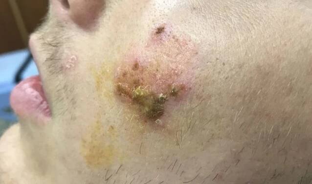 Impetigo - bakteriální infekce postihující kůži