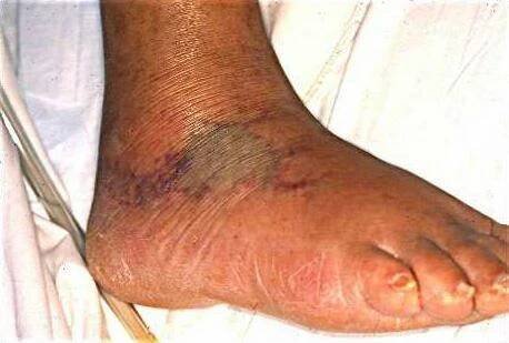 Infekce Vibrio vulnificus
