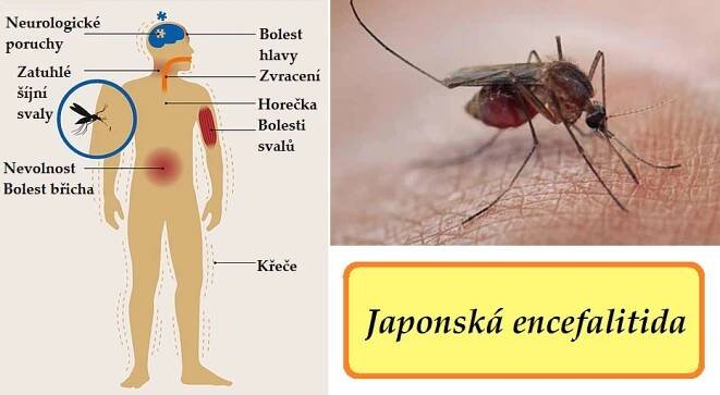 japonska encefalitida priznaky projevy symptomy